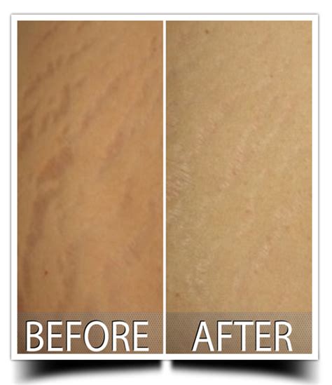 All 93 Images Before And After Laser Stretch Mark Removal Photos