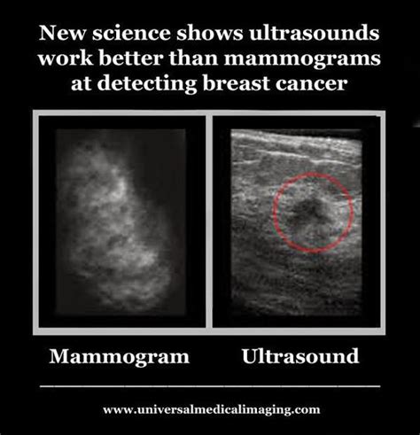 Is A Sonogram Good At Detecting Breast Cancer Updated