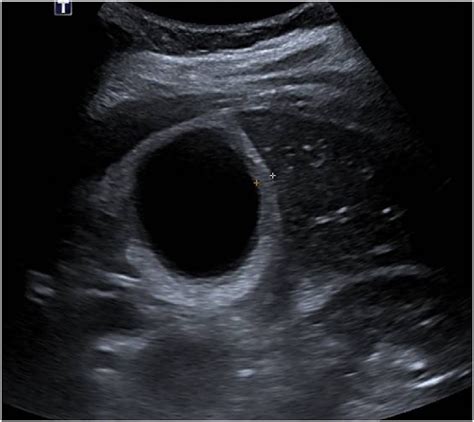 Transverse Gallbladder Ultrasound