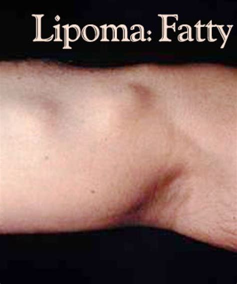 List 98 Pictures A Lipoma Is A Tumor Composed Of Completed 092023