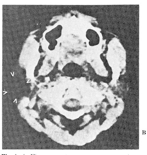 Figure 2 From Dermoid Cysts Of The Head And Neck Semantic Scholar