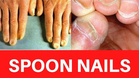Spoon Nails Koilonychia Causes Treatment Symptoms Iron Deficiency Anemia Cure Prevention