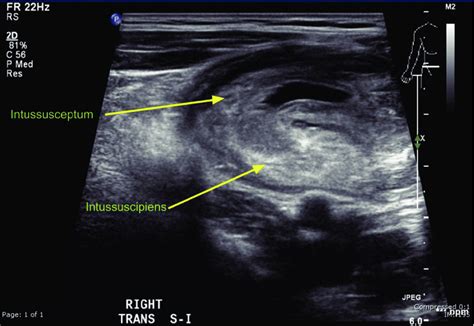 Sonographic Findings Of Intussusceptions Fig 2 Computed Tomography