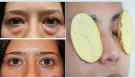 Eye Bags Causes How To Remove Eye Bags Permanently