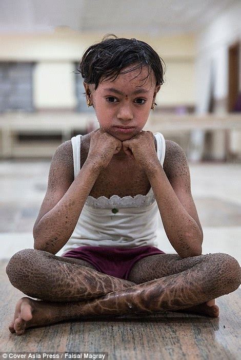 Rare Skin Disease Lamellar Ichthyosis Leaves Brother And Sister With