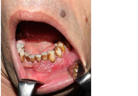 Primary Extranodal Non Hodgkins Lymphoma Mimicking A Painful Gingival