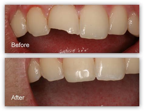 Restoration Of Fractured Teeth Gallery Dr Jack M Hosner Dds