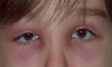 Eyelid Dermatitis Xeroderma Of The Eyelids Eczema Of The Eyelids