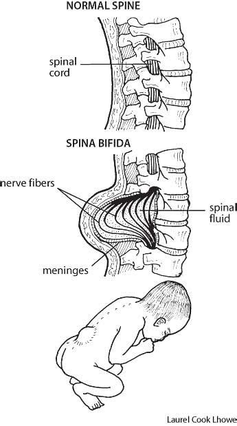 understanding spina bifida definition and overview