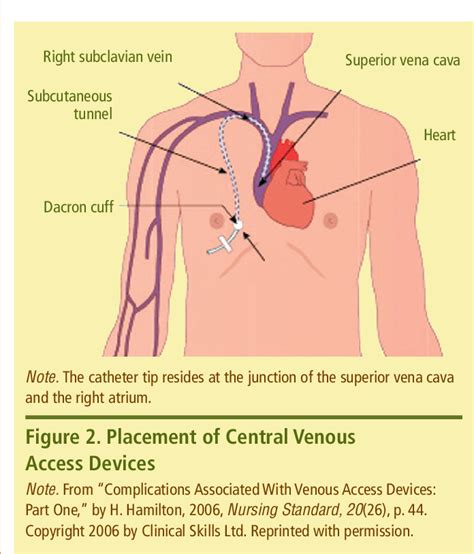 Central Venous Access Device Nursing Interventions Slidesharedocs