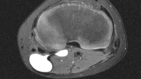 The Mri Appearance And Significance Of The Popliteal Cyst Illinois