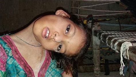 9 year old pakistani girl with hanging head lives as an outcast here s her story health news