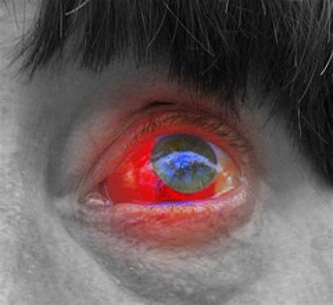 Blood In The Eye Causes Symptoms Treatment Blood In The Eye