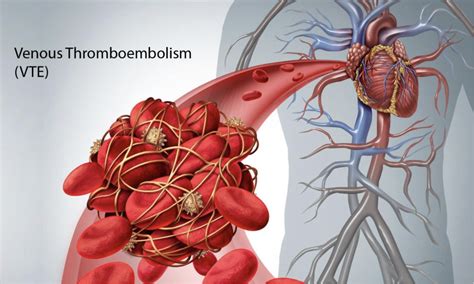 Venous Thromboembolism Vte Vegas Vascular Specialists