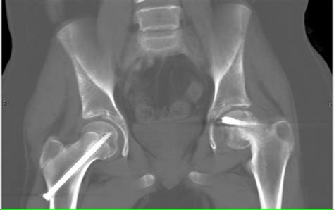 Scfe Slipped Capital Femoral Epiphysis With Failed Pinning Of Left