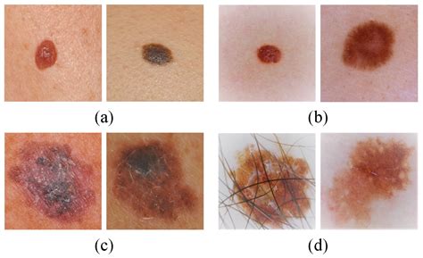 Melanoma Skin Cancer Stages