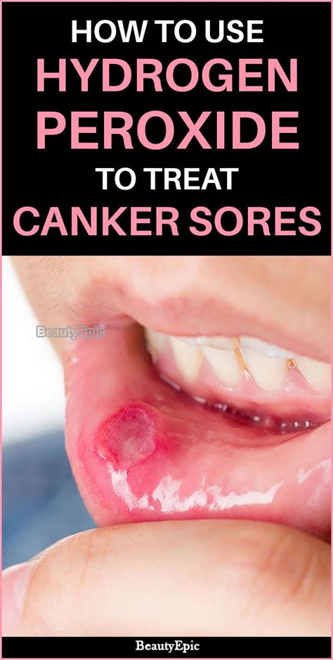 Clean and disinfect small cuts. How to Use Hydrogen Peroxide To Treat Canker Sores ...