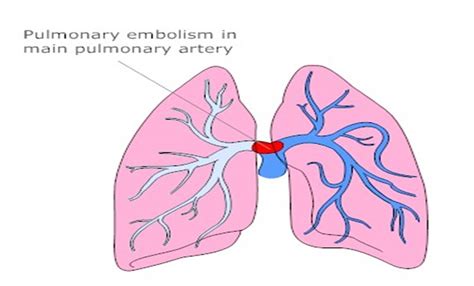 Pulmonary Embolism Anatomy