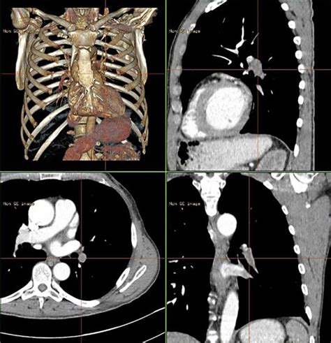 Ct Scan 7 Months After Completion Of Adjuvant Chemotherapy