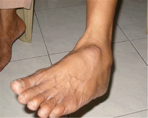 Swelling On The Dorsal Surface Of Left Foot Download Scientific Diagram