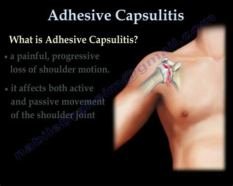 Adhesive Capsulitis Frozen Shoulder Everything You Need To Know