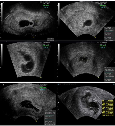 Six Cases Of Distorted Gestational Sac A Cases In Group Of