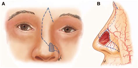 A Frontal View Of An Additional Myocutaneous Rotation Flap From The