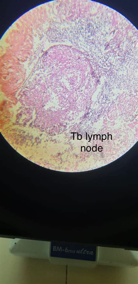 Tb Lymph Nodes Lymph Nodes Pathology Globe