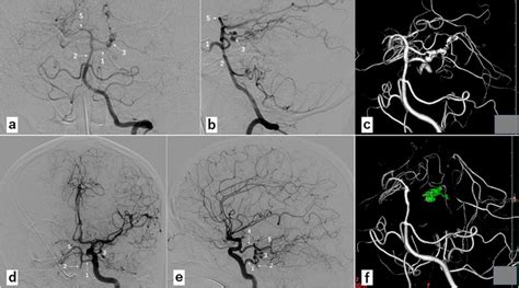 Digital Subtraction Angiography Of The Patient Before A E And After Download Scientific