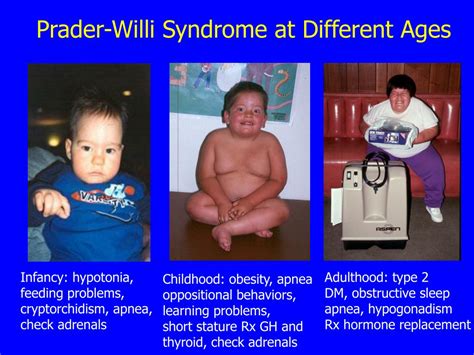 Ppt Update On Medical Issues In Prader Willi Syndrome Powerpoint