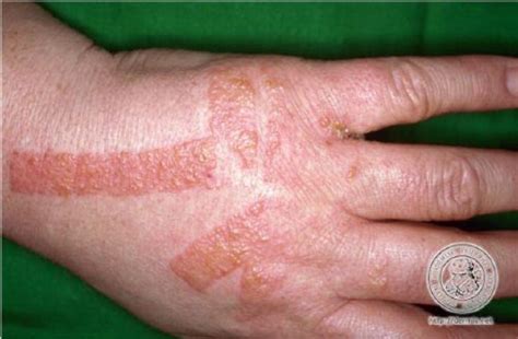 Occupational Risk Assessment And Irritant Contact Dermatitis Ann R