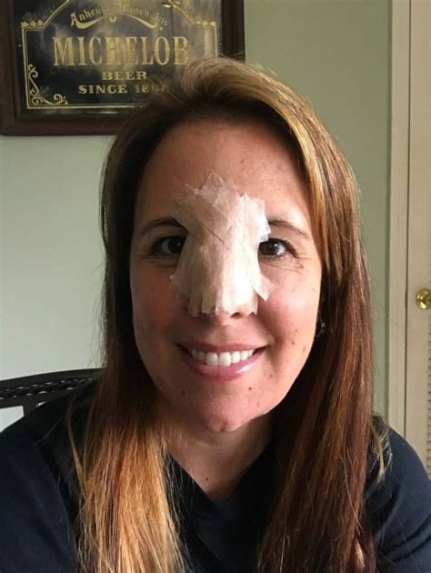 Basal Cell Carcinoma Mohs Surgery Moscato Mom