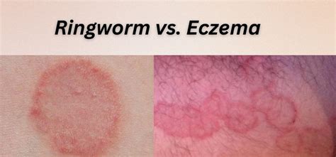 Ringworm Vs Eczema Medical Elevate