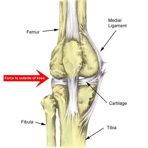 Medial Knee Ligament Mcl Sprain Symptoms Treatment And Exercises