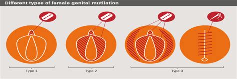The practice has no health benefits. FGM - My Story #16Days - Soroptimist International