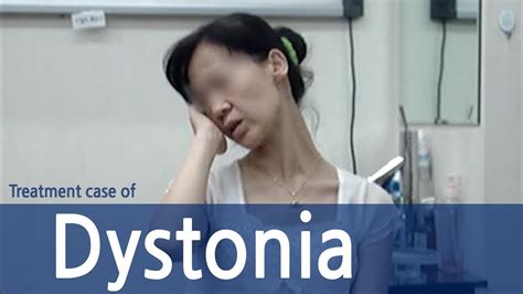 Dystonia Cervical Dystonia 사경증 치료사례 근긴장이상증 Youtube