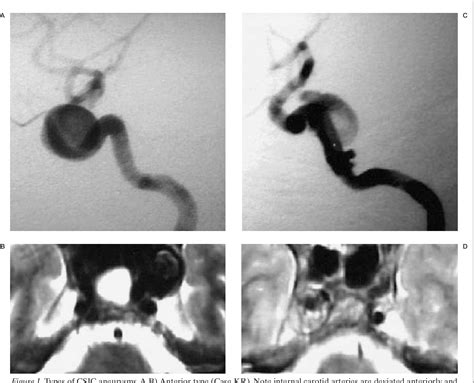 Figure 1 From Symptomatic Cavernous Internal Carotid Artery Aneurysms