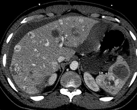 liver atlas case  angiosarcoma ruptured metastases