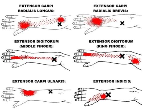 The Definitive Guide To Wrist Extensors Anatomy Exercises And Rehab