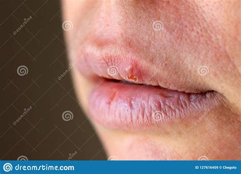 Herpes On The Lip Close Up Macro Stock Image Image Of Person