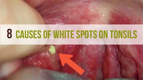 White Patch On Tonsil For Months Sharedoc
