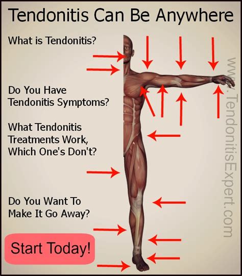 Tendonitis Information On Treatment Symptoms You Wont Find Anywhere Else