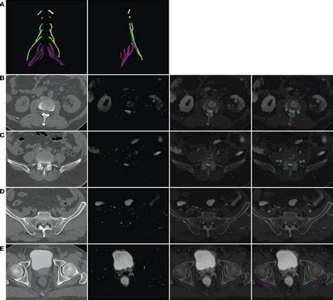 Frontiers Contouring Lumbosacral Plexus Nerves With Mr Neurography