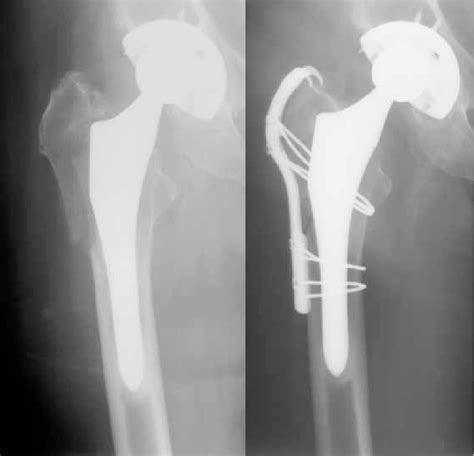 Patient With A Fracture Of The Greater Trochanter With Severe