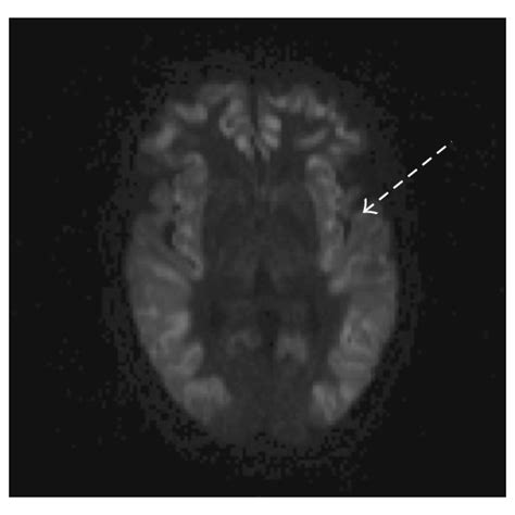 Mri Of The Brain Six Hours After The Onset Of Se A B And C