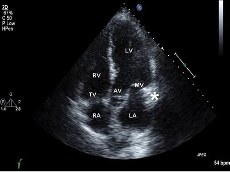 Figure 2 Two Dimensional Echocardiogram Apical Long Axis 5 Chamber