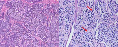 Light Microscopy Of Typical And Atypical Pulmonary Carcinoid Tumors