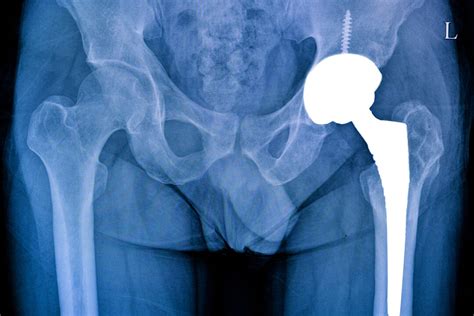 Types Of Hip Replacements Dr Gregory Hicken
