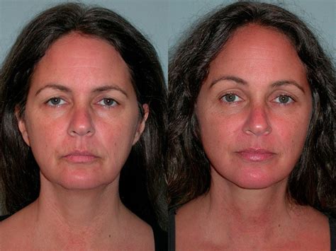 Note her forehead wrinkles improved too since she doesn't need to lift her forehead as much. Brow Lift Santa Rosa - Facial Cosmetic Surgery | Artemedica