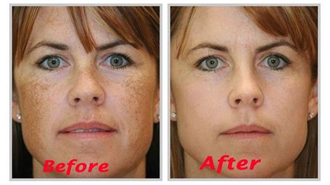 Age Spots Treatment Bedford Skin Clinic